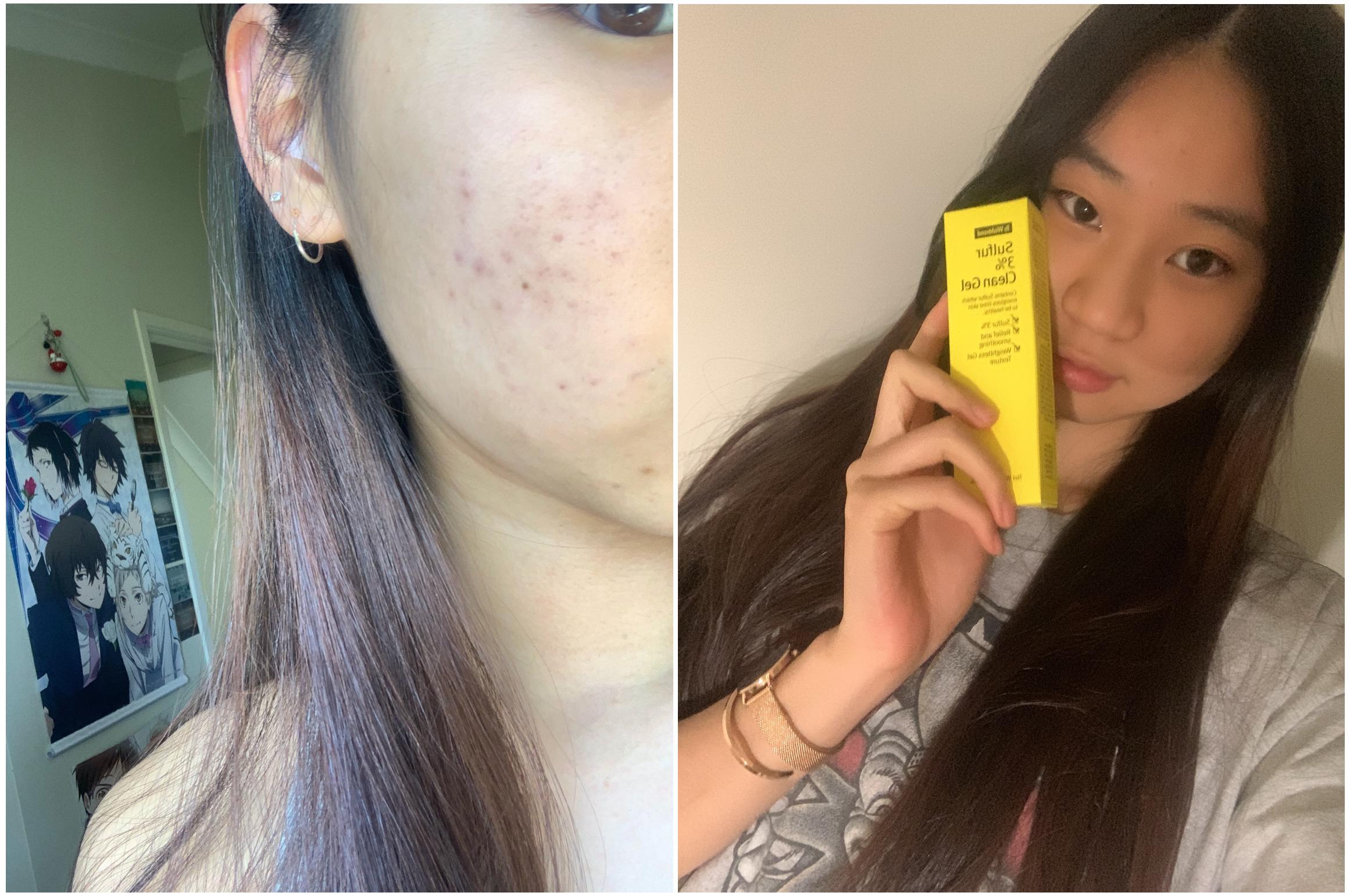 #YAYNAY TESTER TEAM: By Wishtrend Sulfur 3% Clean Gel 🌝- Mid 10s